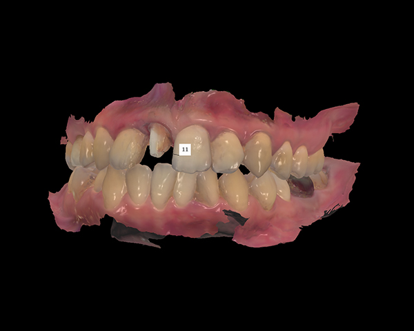 歯の型