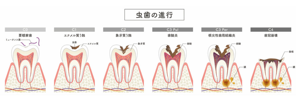 虫歯の進行｜小野歯科