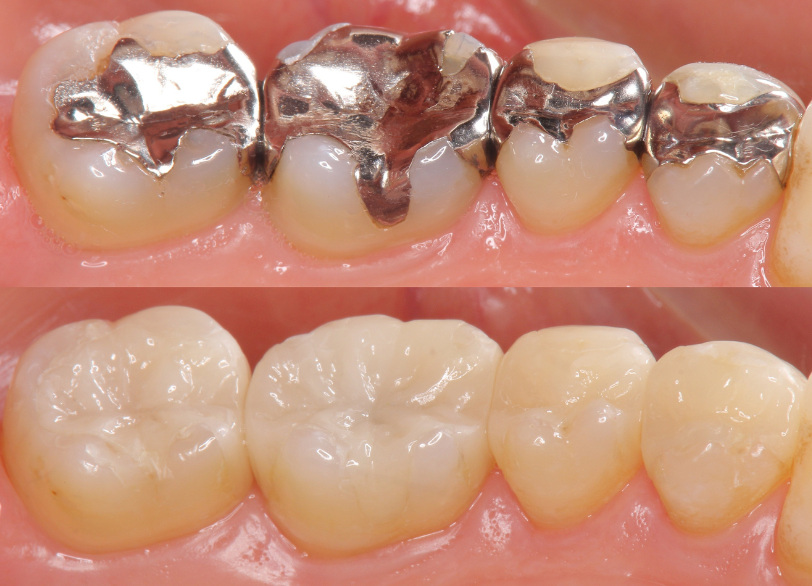メタルフリー治療｜小野歯科