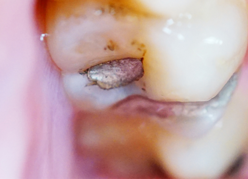 アマルガム除去｜小野歯科