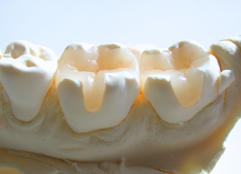 セラミックインレー｜小野歯科