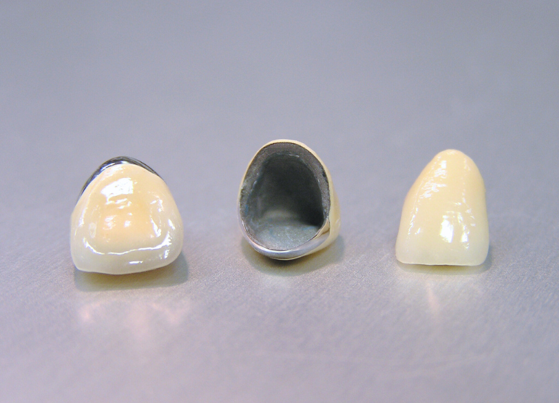 メタルボンドクラウン｜小野歯科