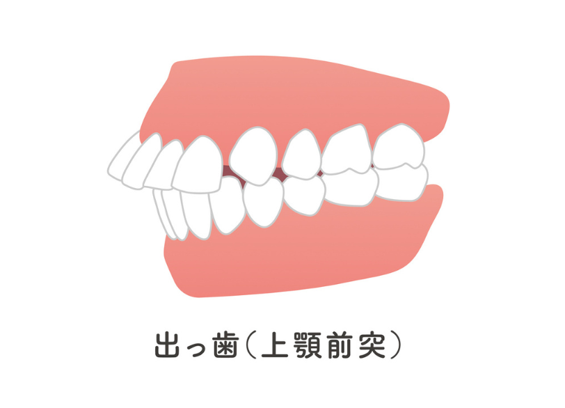 上顎前突｜小野歯科