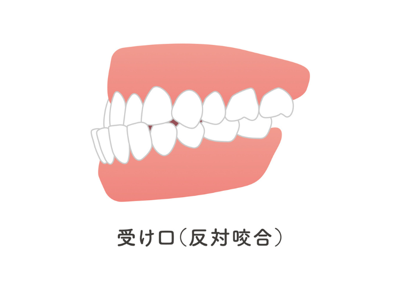 反対咬合｜小野歯科