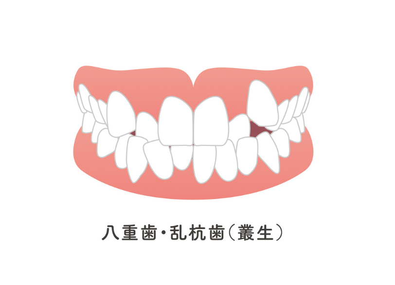 叢生｜小野歯科