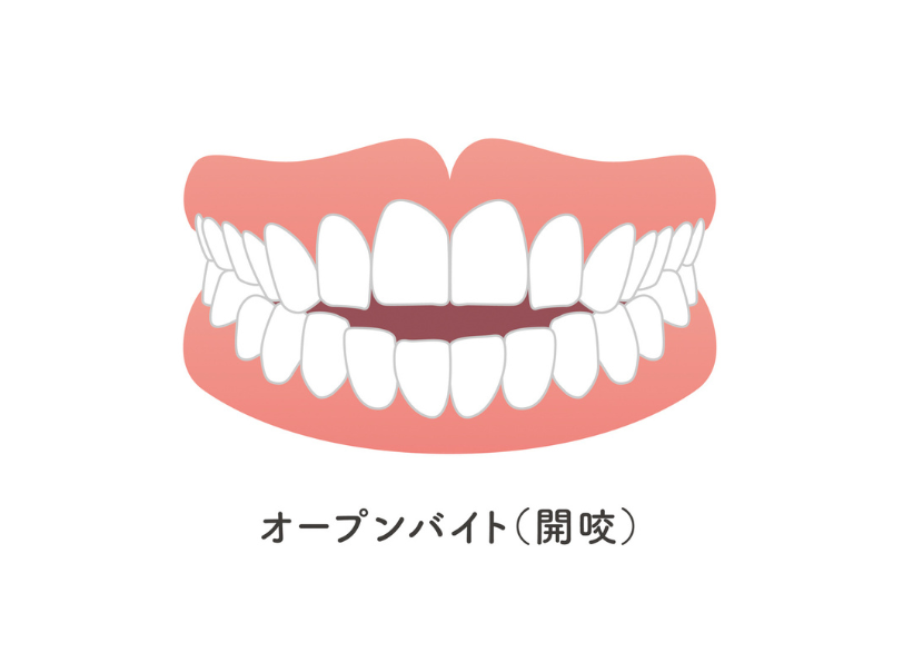 開咬｜小野歯科