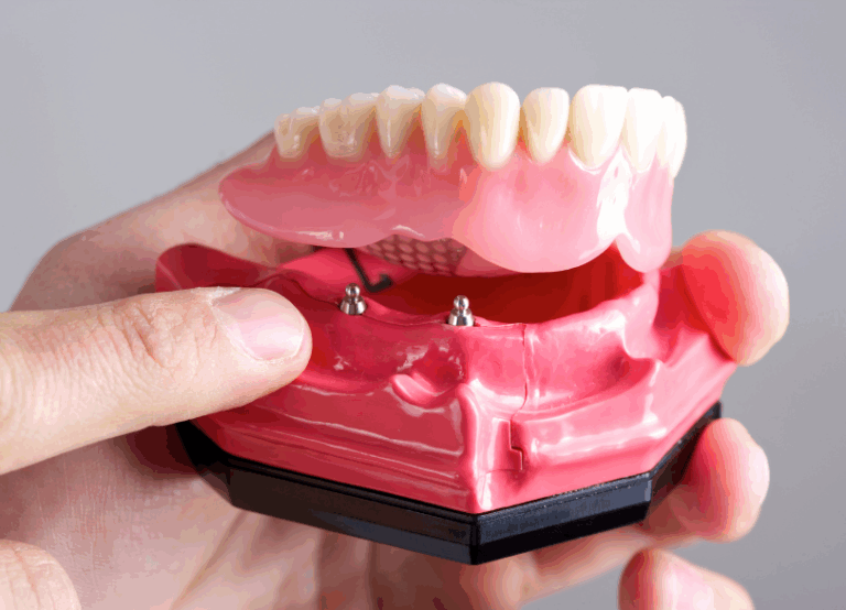 インプラントオーバーデンチャー|小野歯科