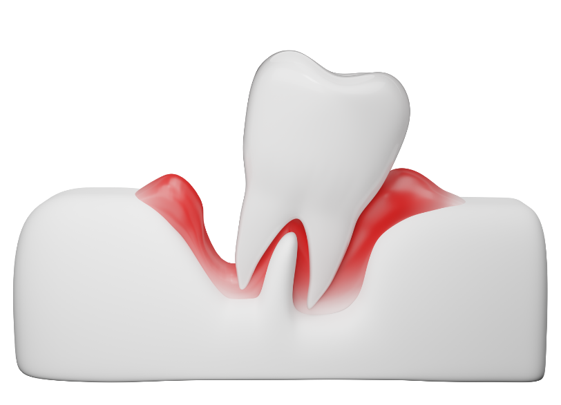 歯周病で歯を失った|小野歯科