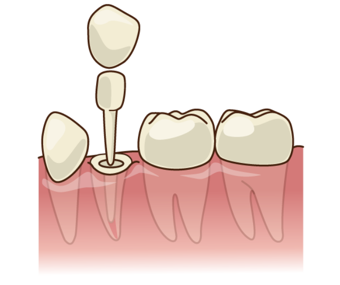 差し歯|小野歯科