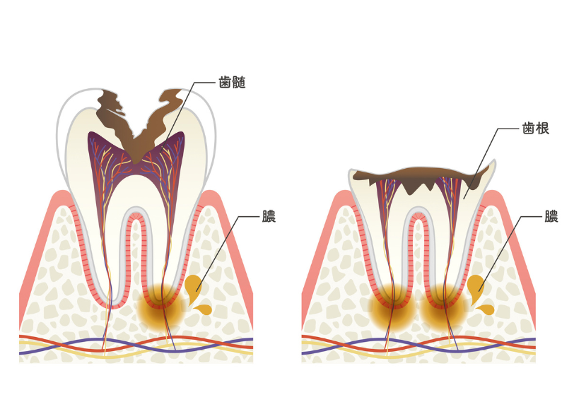 歯がボロボロ|小野歯科