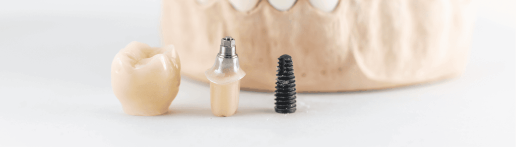 インプラント治療に関する様々な疑問|小野歯科