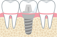 インプラント|小野歯科