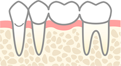ブリッジ|小野歯科