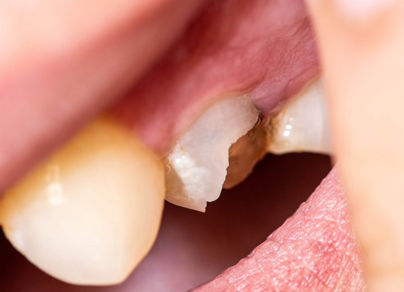 歯へのダメージ｜小野歯科