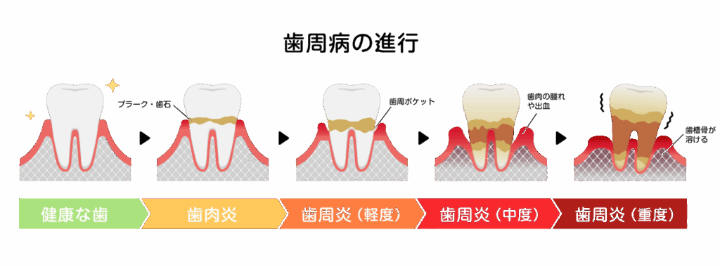 歯周病の進行｜小野歯科