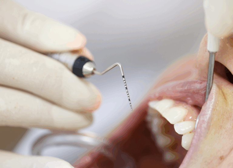 歯周ポケット検査|小野歯科