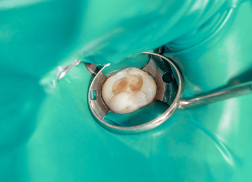 根管充填｜小野歯科