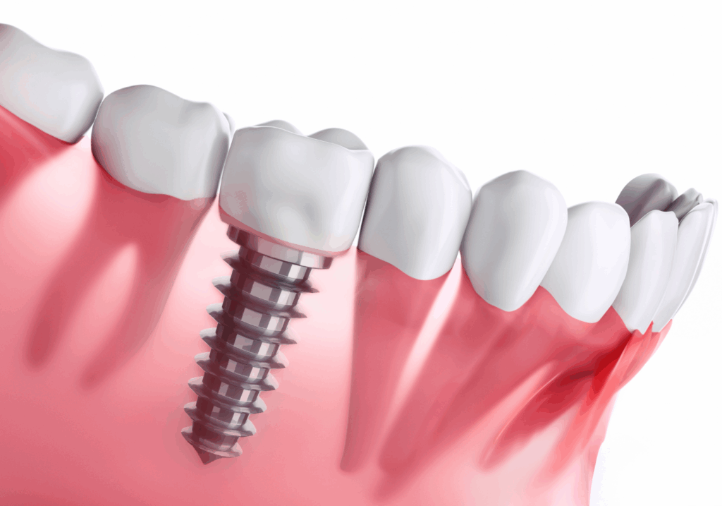 インプラントは第二の永久歯|小野歯科