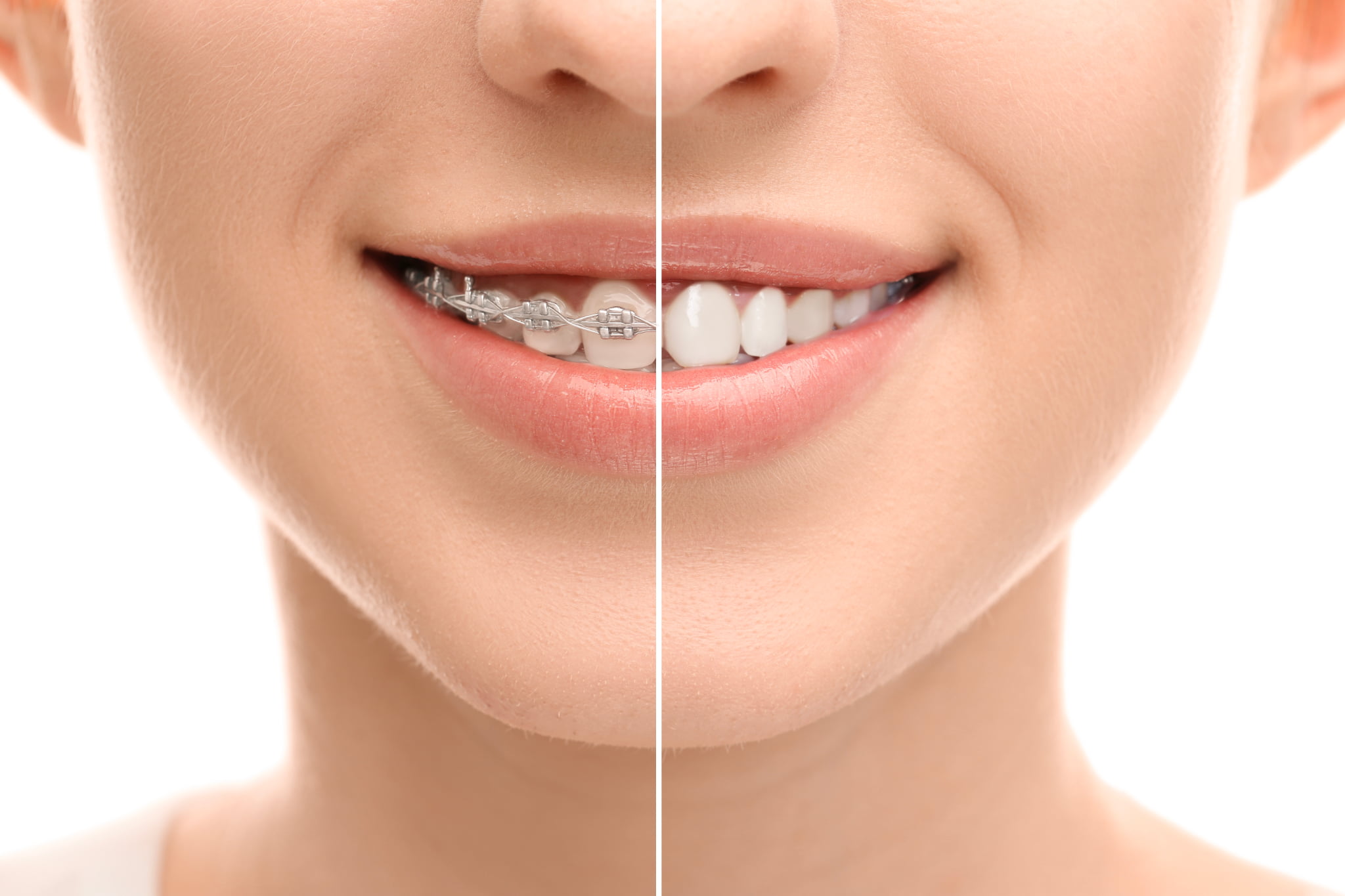 審美歯科治療をした前後のイメージ
