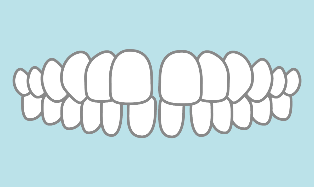 すきっ歯のイメージイラスト