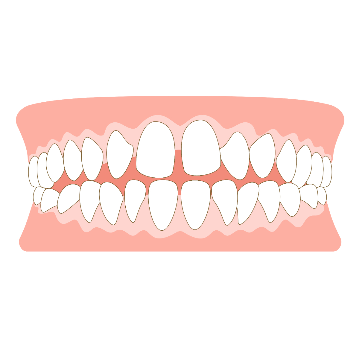 すきっ歯のイラスト