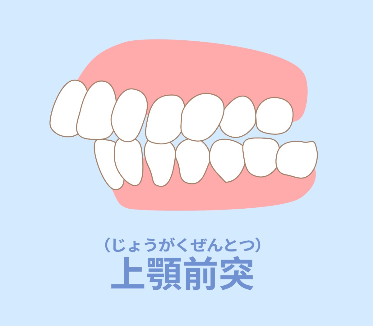 出っ歯とは？