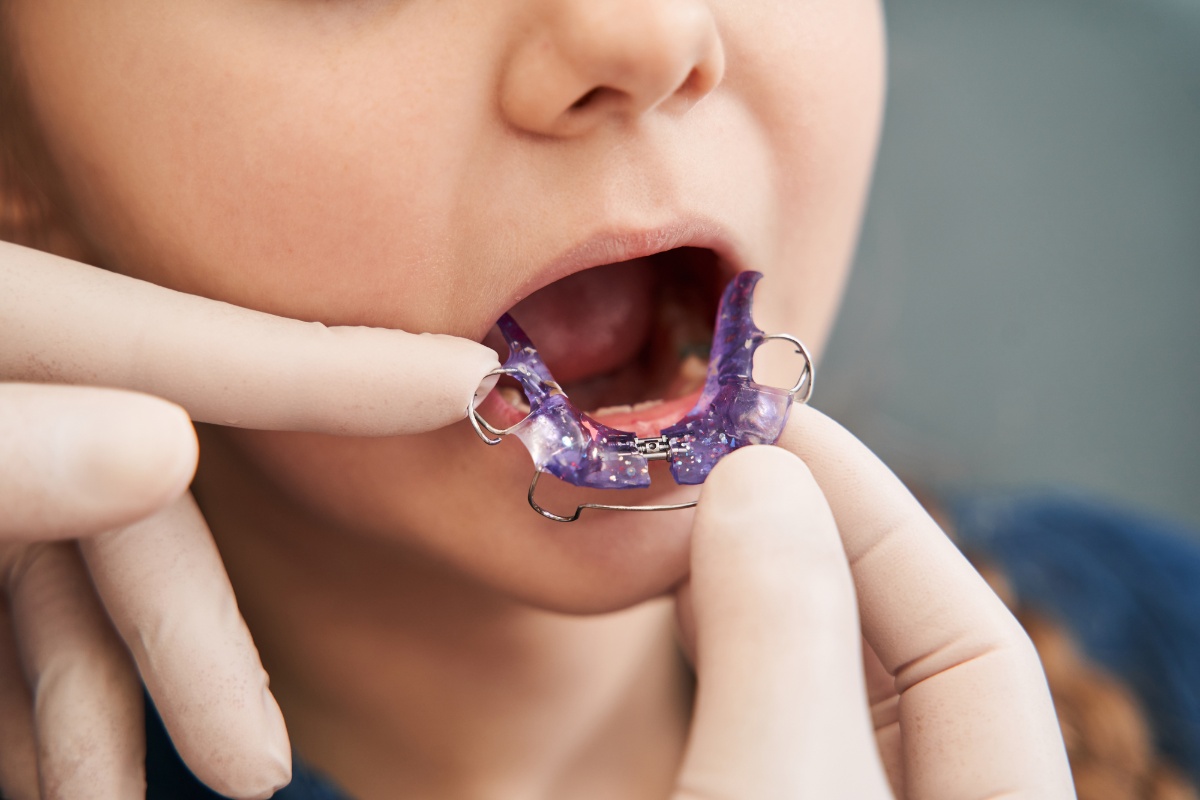 歯科医に床矯正の装置を装着してもらっている子どもの口元